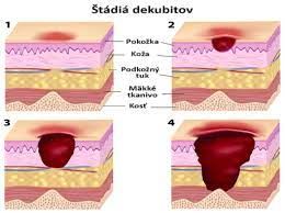 ŠTÁDIÁ DEKUBITOV